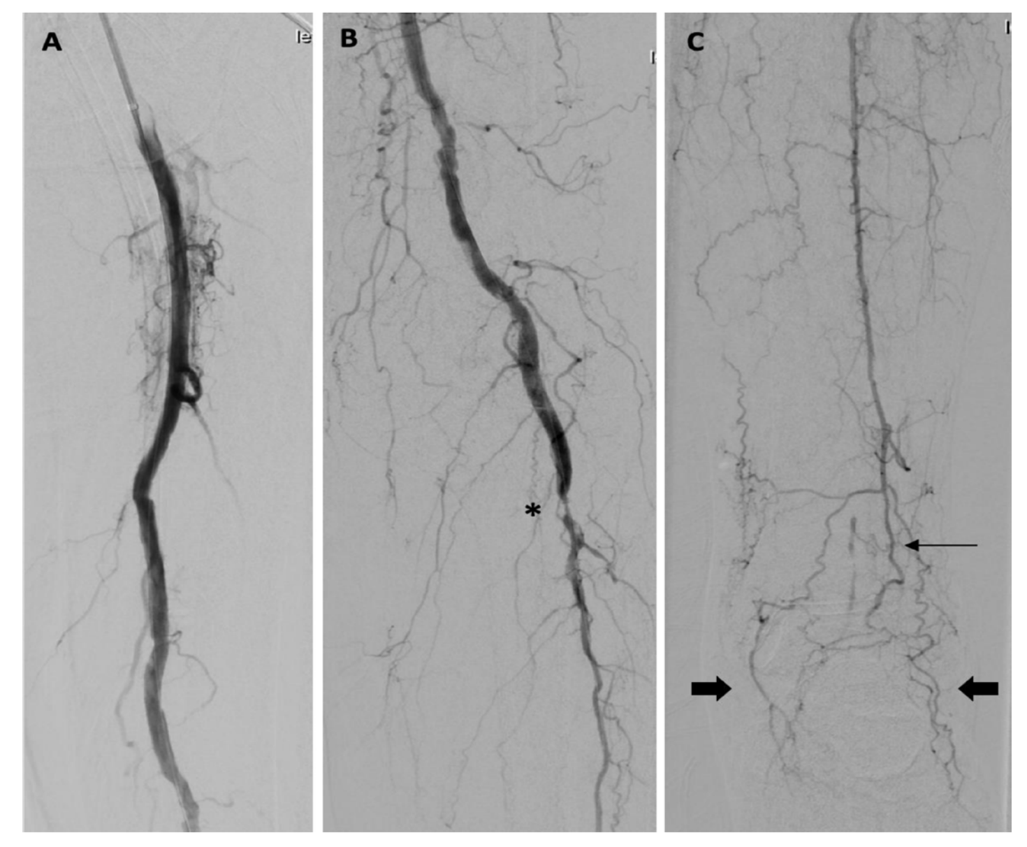Acute Limb Ischemia Clot and Catheter VDM